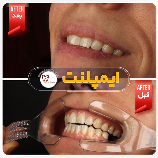 نمونه درمان ایمپلنت دندان در کرج و فردیس و تهران