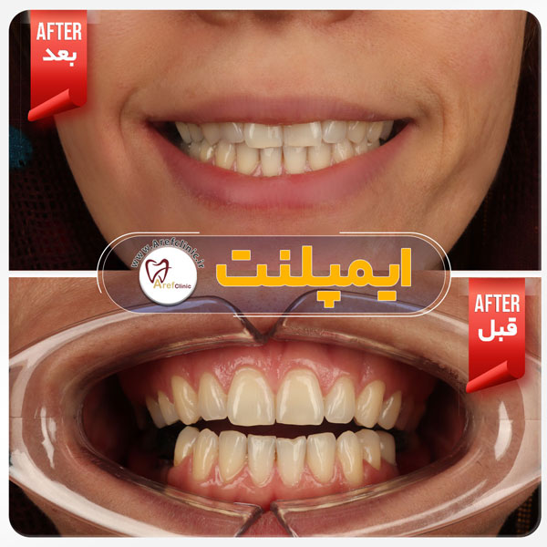 نمونه درمان دندان پزشکی ایمپلنت دندان در کرج