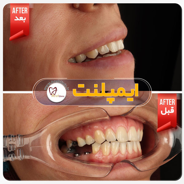 نمونه کار کاشت دندان در کرج
