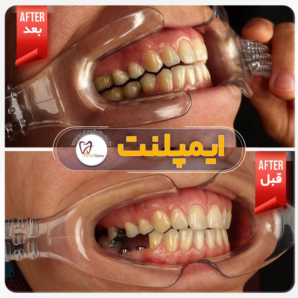 نمونه کار درمان ایمپلنت دندان در کرج