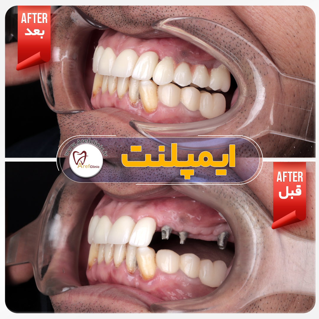 نمونه کار های ایمپلنت دندان در کرج