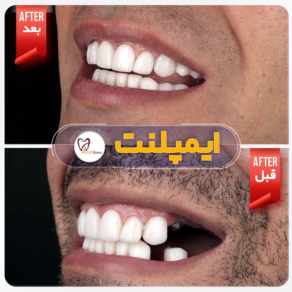 نمونه کار های ایمپلنت دندان در کرج
