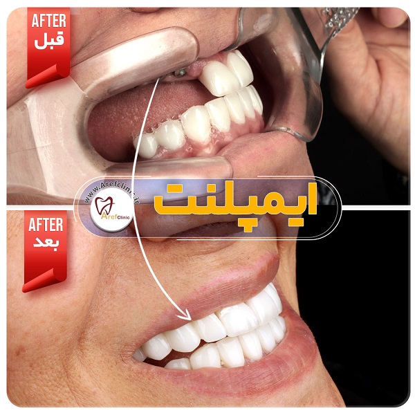 نمونه کار های ایمپلنت دندان در کرج