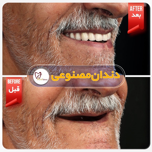 نمونه کار دندان مصنوعی در کرج