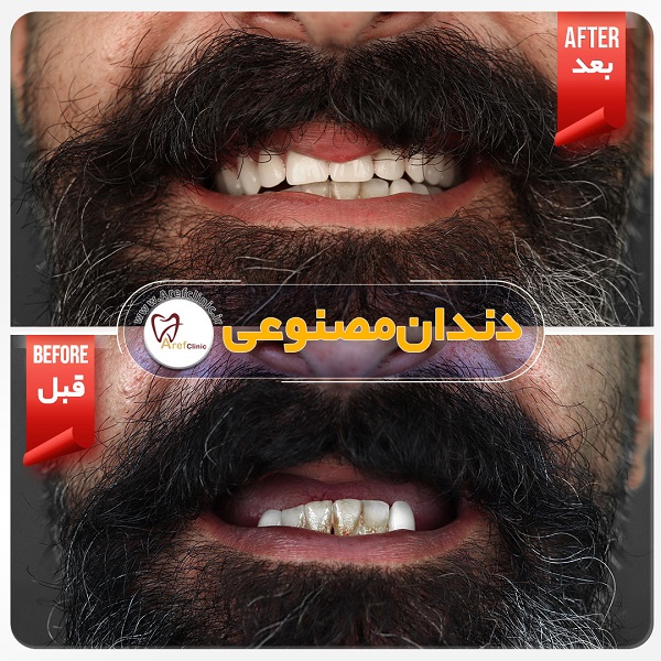 نمونه کار دندان مصنوعی در کرج