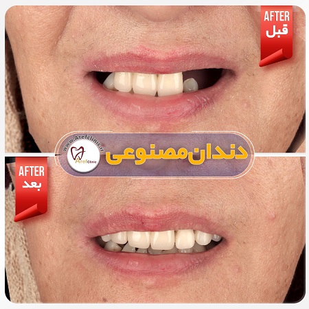 نمونه کار کلینیک دندان مصنوعی در کرج