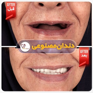 نمونه کار ساخت دندان مصنوعی در کرج