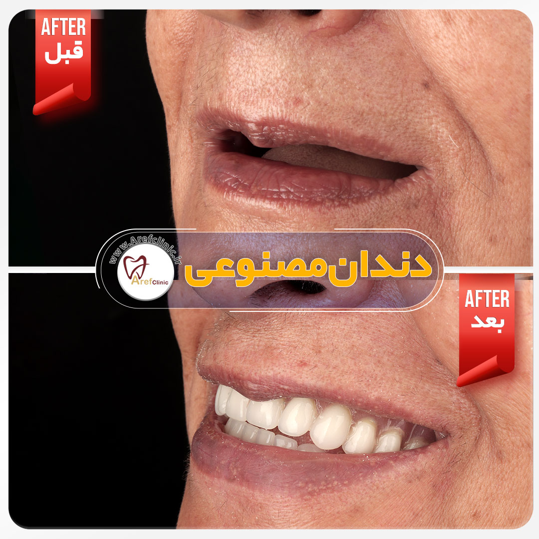 نمونه کار ساخت دندان مصنوعی در کرج