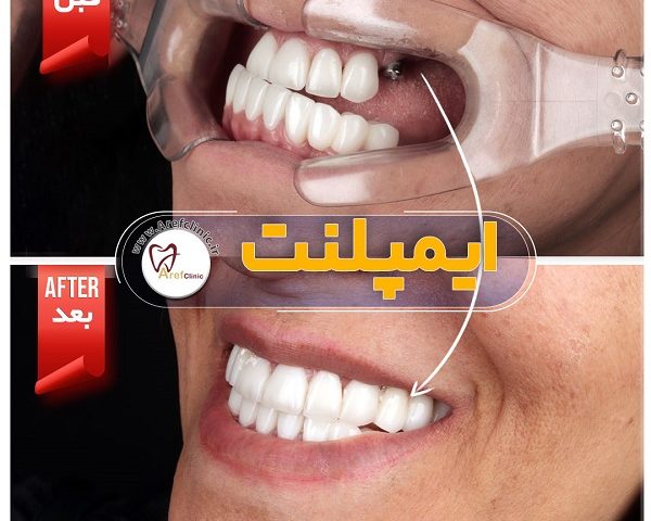 ایمپلنت دندان در کلینیک دندان پزشکی کرج دکتر عارف