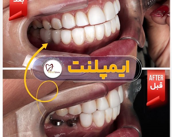 ایمپلنت دندان در فردیس کرج